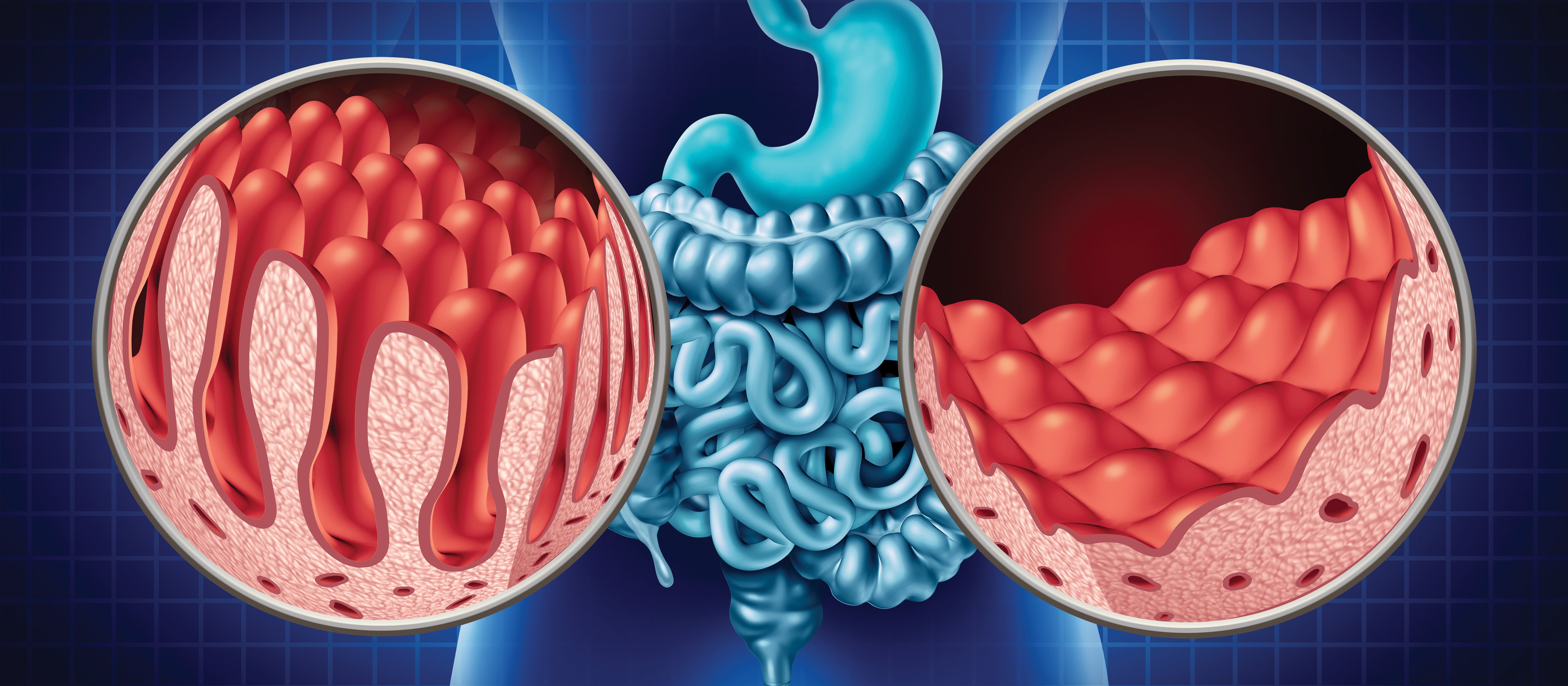 Dietary Needs For Coeliac Disease